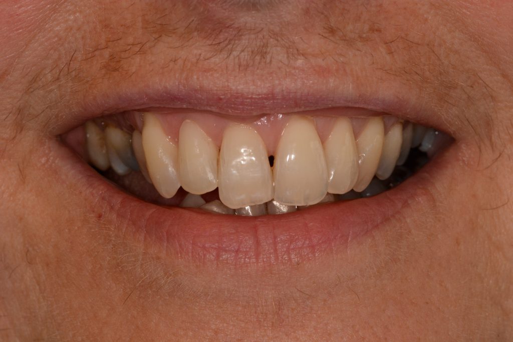 Introducing Inman Aligners Orthodontics Shrewsbury