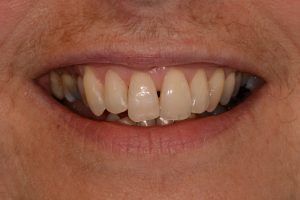 After Pic Clearsmile