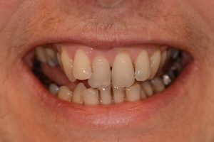 Before Pic Clearsmile